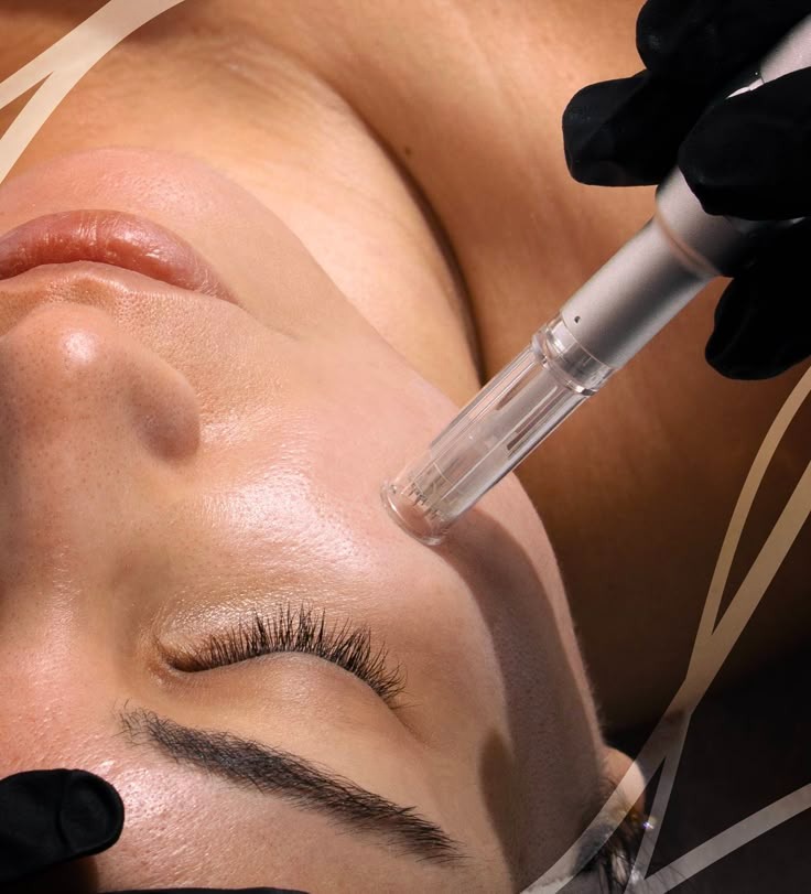 Dermapen + Hidralips