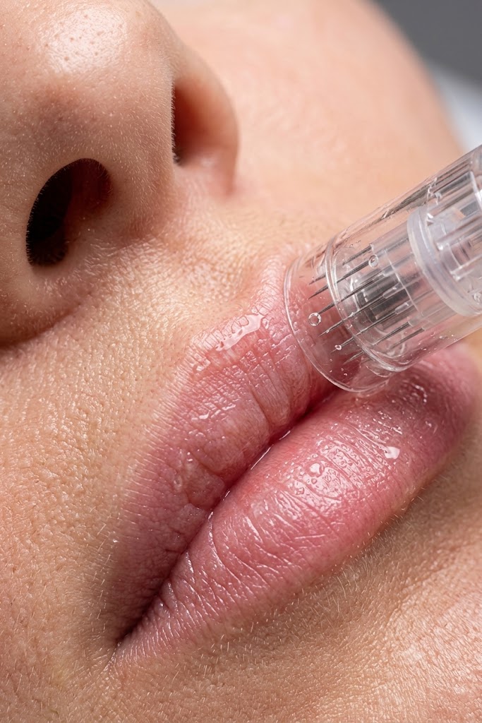 Dermapen + Hidralips - detalle